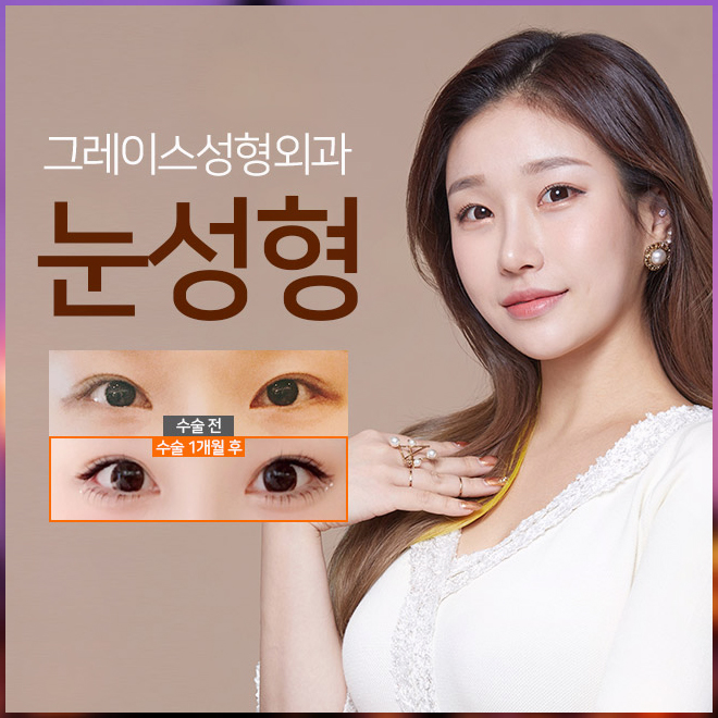 쌍수종류 자연유착?절개? 그레이스가 알려드려요 관련 이미지 1