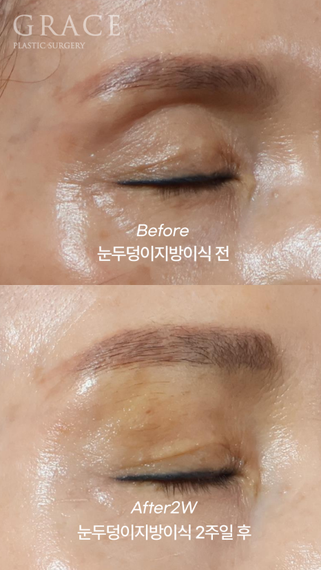 60대 중년 눈두덩이 안와지방이식 1cc 전후 관련 이미지 4