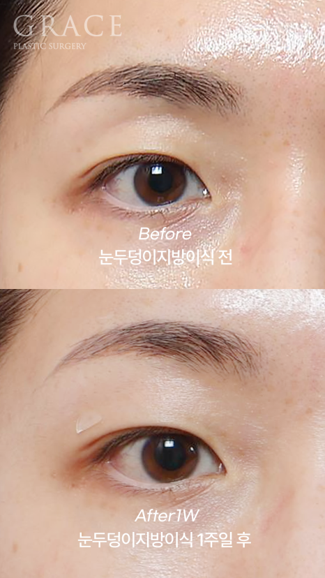 Eyebrow Fat Grafting &middot; Eyelid Fat Grafting &middot; Sunken Eyes Surgery Cost Information (As of June 2025) image 5