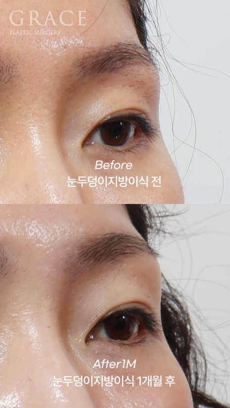 눈두덩이 지방이식 or 풀페이스 지방이식 유지기간&middot;부작용까지 정리 관련 이미지 9