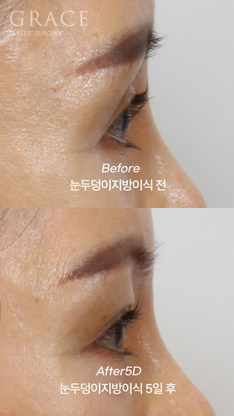 How Long Can Sunken Upper Eyelids Last Without Side Effects After Fat Grafting? image 9