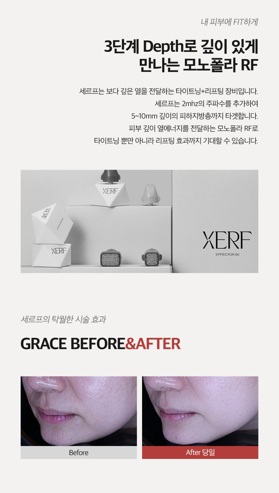 울쎄라의 통증 걱정된다면 세르프 리프팅 관련 이미지 2