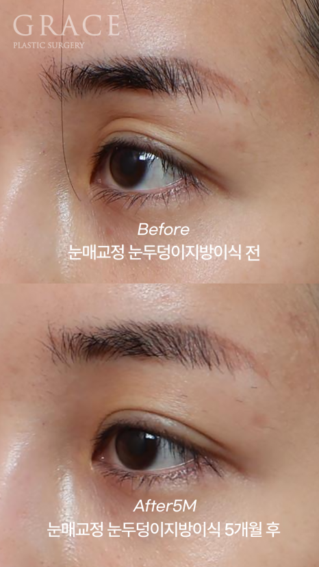 (2차 냉동지방 NO) 생지방으로 자연스럽게 채운 눈두덩이  붓기/부작용 걱정 없이 관련 이미지 5