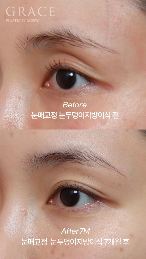 [20대 후반 눈꺼풀 지방이식+눈매교정]  7개월 후 유지력 이렇게 좋을 일? 관련 이미지 6