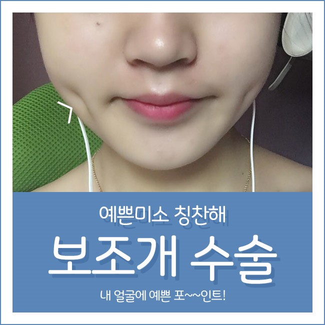 내 얼굴에 예쁜 포인트, 그레이스성형외과 보조개 수술 관련 이미지 1