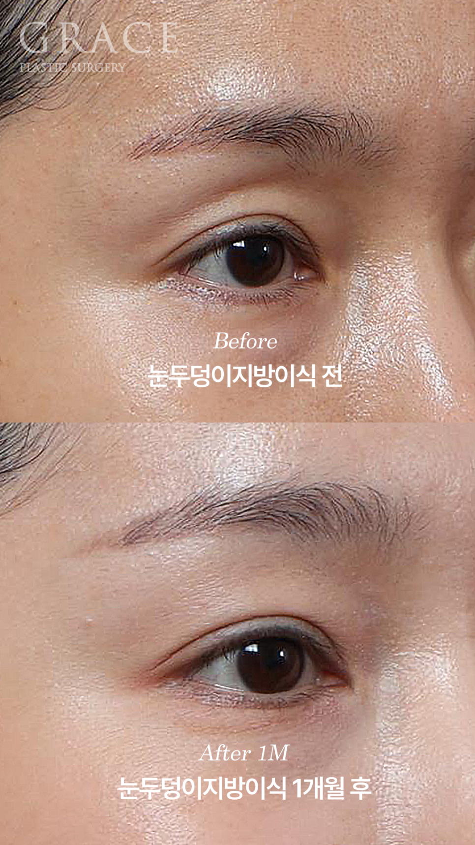 Why Choose Upper Eyelid Fat Grafting Instead of Eye-Hollow Filler? image 9