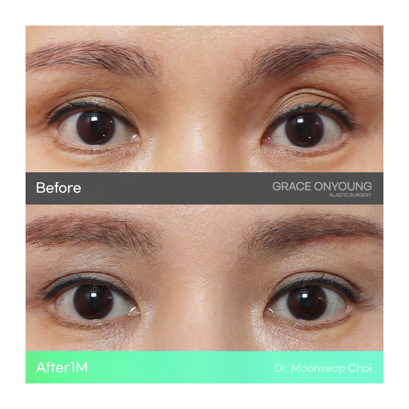 Shocked After Hearing That My Hollow Eyes and Sunken Eye Holes Were Severe? Upper Eyelid Fat Grafting image 7