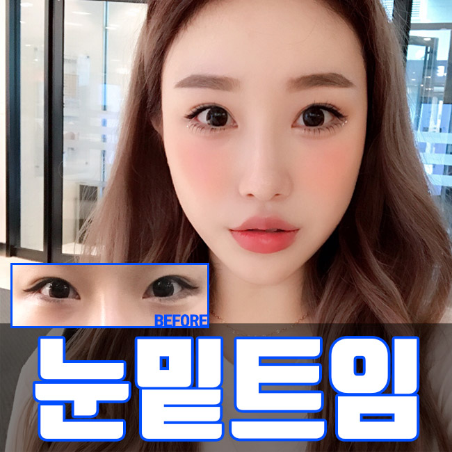 듀얼트임의 시작, 그레이스성형외과 뒷트임밑트임후기 관련 이미지 3