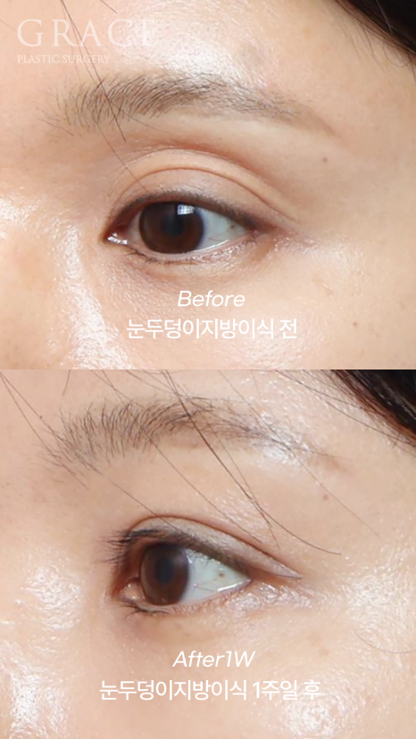 눈두덩이 지방이식 가격보다는 주입방식 관련 이미지 6
