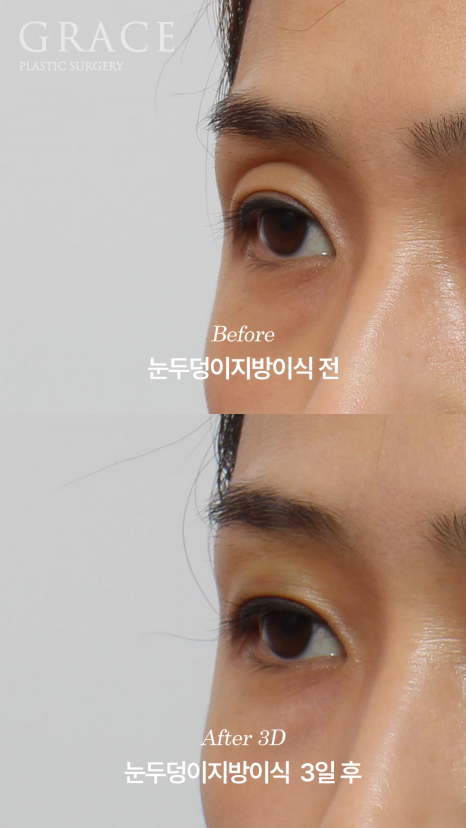 The Most Frequently Asked Symptom After Eyelid Fat Grafting: Yellow Bruising on the Eyelids image 3
