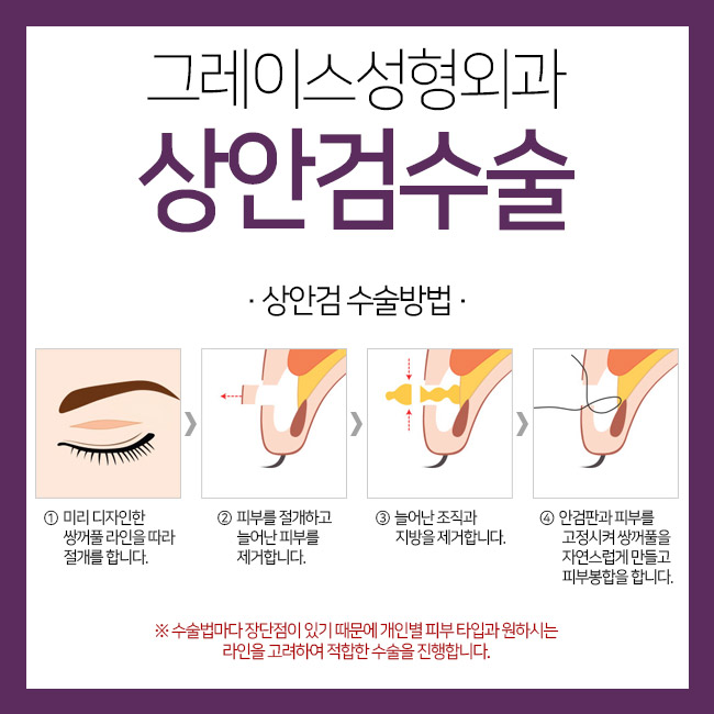 처지고 늘어진 눈꺼풀을 해결해주는 상안검수술비용 관련 이미지 4