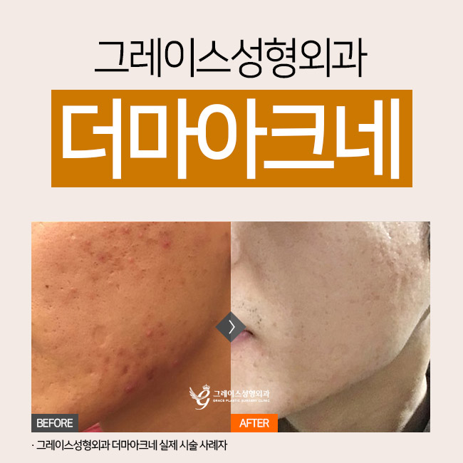 Dherma Acne at a Place That Does Acne Treatment Well image 2