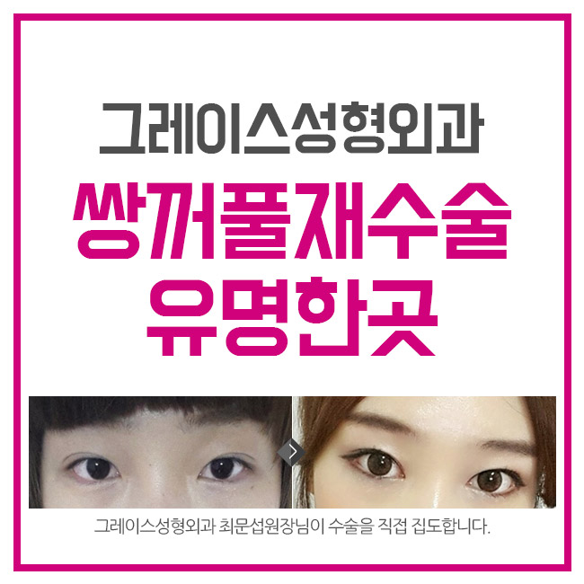 쌍꺼풀재수술유명한곳을 알아본다면? 관련 이미지 3