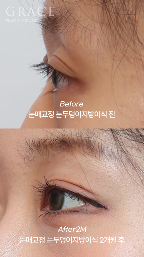 꺼진 눈두덩이 필러 대신 지방이식? 붓기&middot;부작용 없는 방법 정리 관련 이미지 2