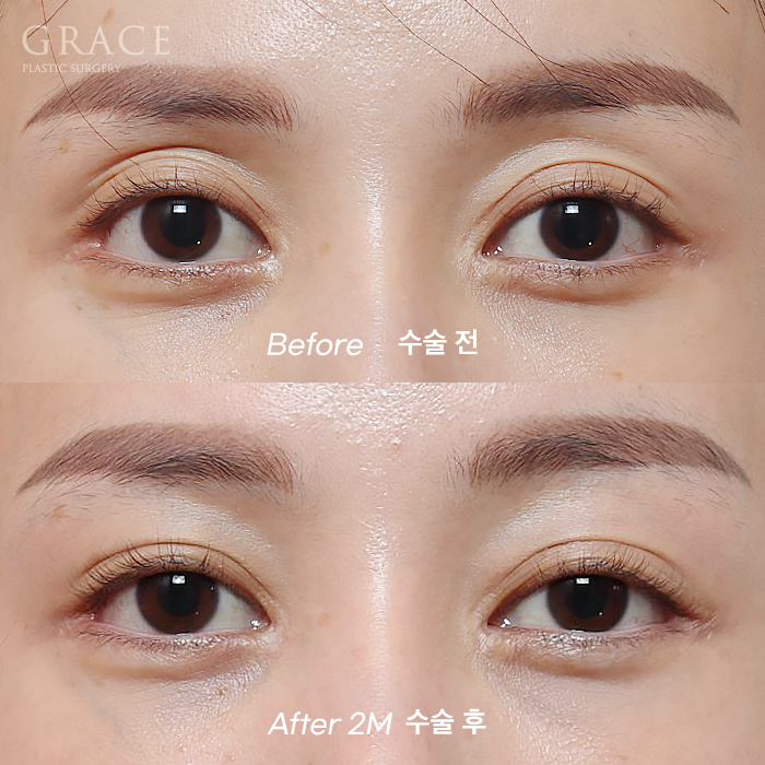 Eyebrow Fat Grafting &middot; Eyelid Fat Grafting &middot; Sunken Eyes Surgery Cost Information (As of June 2025) image 9