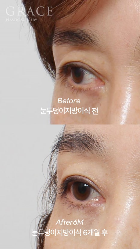 Eyebrow Hollow Fat Grafting Before and After Comparison – Gently Filling Sunken Eyes image 7