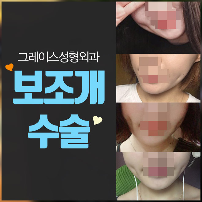 보조개수술전후, 매력 포인트를 주다! 관련 이미지 2