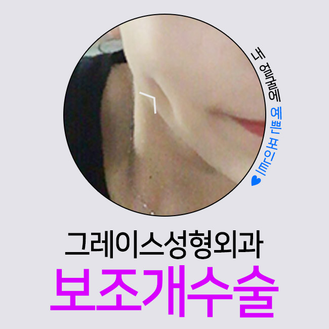 보조개수술 후기를 찾고있다면? 관련 이미지 1
