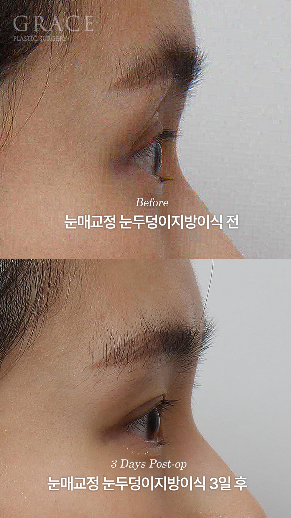 눈매교정 망하고 눈재수술 &middot; 눈두덩이 안와지방이식 관련 이미지 7