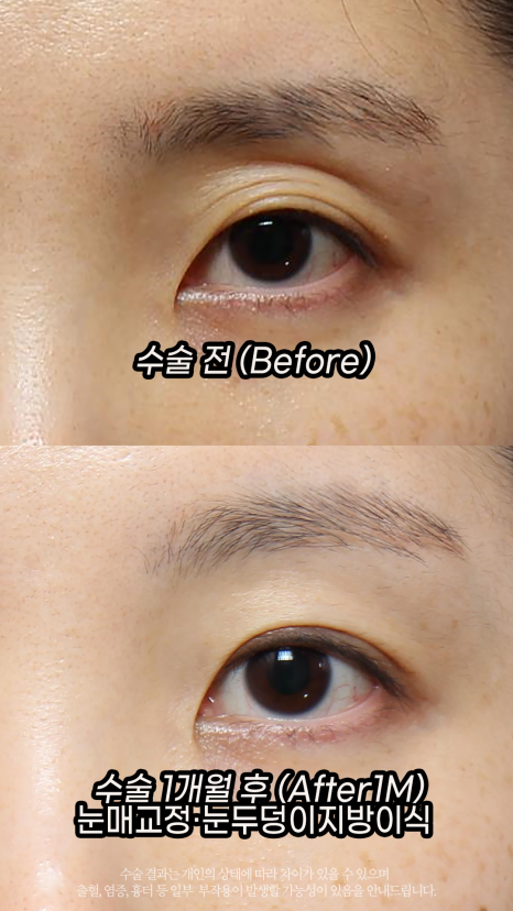 If Sunken Eyelids Are Left Untreated, About Hollows in the Eye-Hole Area (Fat Grafting) image 1