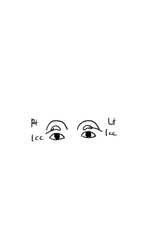 Eyelid Fat Grafting Side Effects? How to Settle In Beautifully Without Lumps image 2