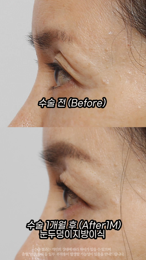 A Story About the Longevity of Eyelid (Eye Hole) Fat Grafting by Grace Plastic Surgery image 3
