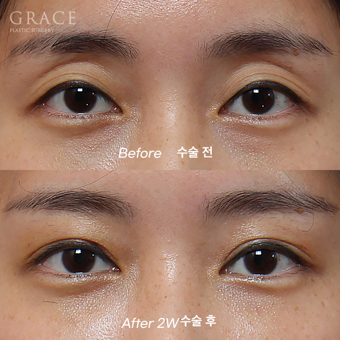 30대 눈두덩이 지방이식 + 눈매교정 + 눈밑지방재배치 BEFORE & AFTER 관련 이미지 1