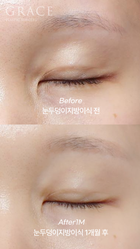 아이홀 꺼짐? 필러 말고 눈꺼풀 지방이식으로 해결했어요 (지방뭉침 없이) 관련 이미지 5