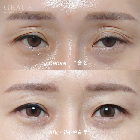 그레이스성형외과 Before&middot;After 아이홀 지방이식 잘하는 곳 관련 이미지 6