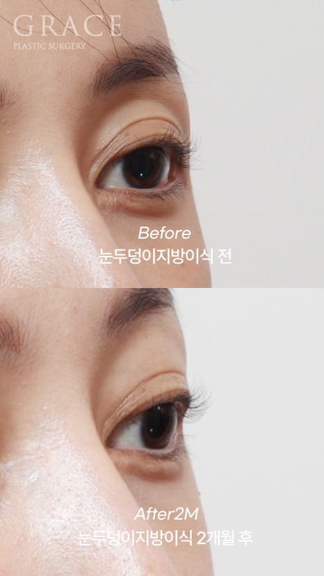 Eyebrow Fat Grafting &middot; Eyelid Fat Grafting &middot; Sunken Eyes Surgery Cost Information (As of June 2025) image 13