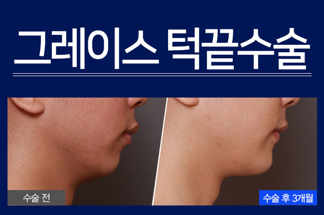 턱끝수술로 남성미를 더하다 관련 이미지 2