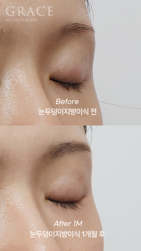 돌출눈·눈위 꺼짐으로 고생하는 사람이라면? 관련 이미지 6
