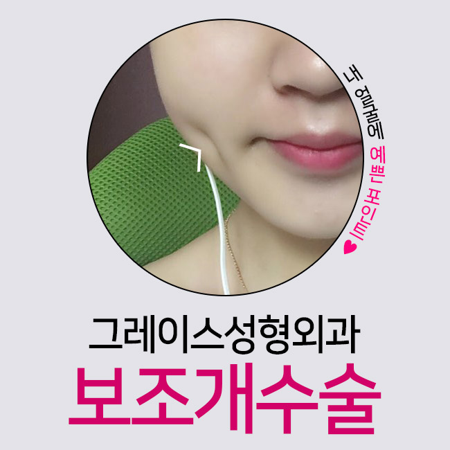 보조개수술로 상큼한 미소를 갖다♡ 관련 이미지 3
