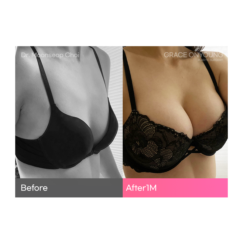 A Plastic Surgery Clinic That Does UU Line Breast Augmentation Well image 4