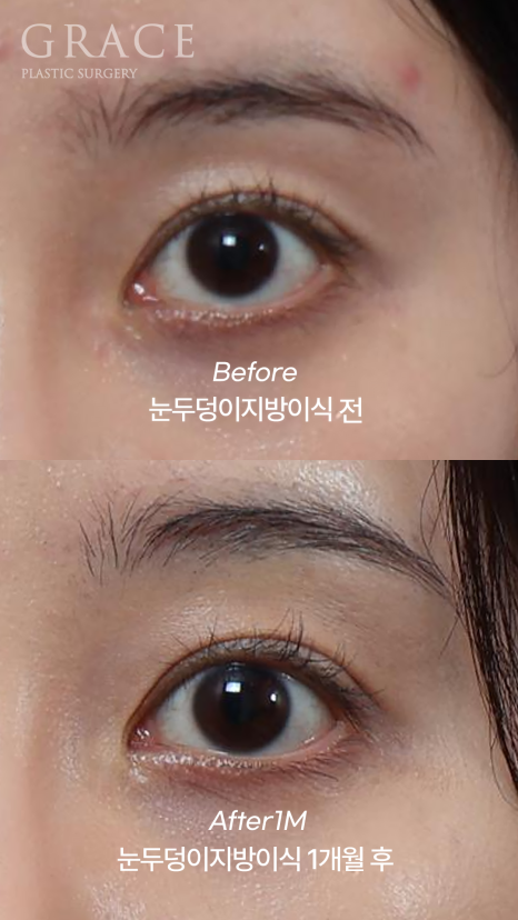 For Those Saddened by Sunken Eyelids (Upper-Eyelid Fat Grafting) image 5