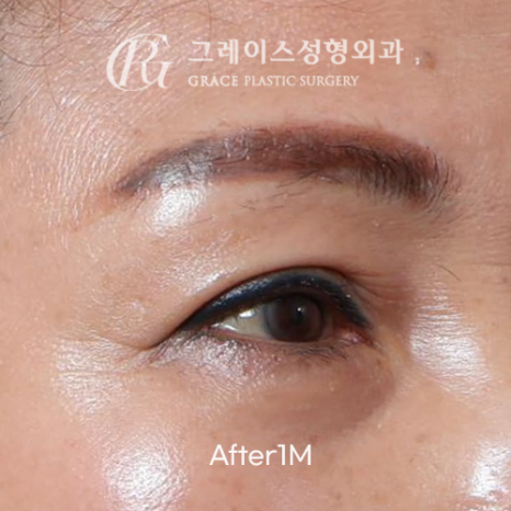 60대 눈꺼풀 고민 상안검 대신 선택한 눈두덩이 지방이식 관련 이미지 3