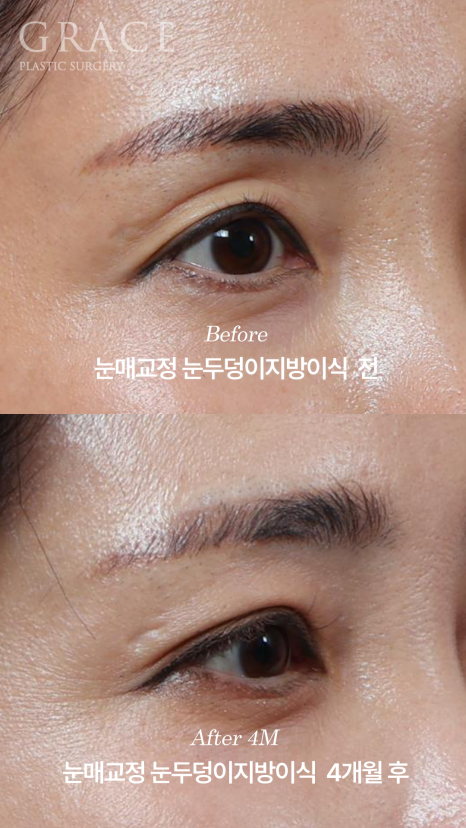 눈두덩이지방이식 11개월 후 부작용 없이 유지되는 변화 관련 이미지 6