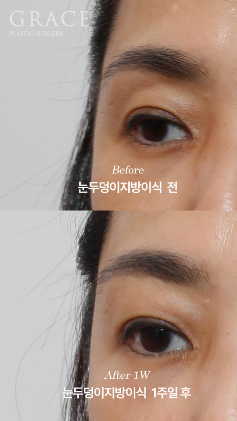 눈두덩이 부위에 절개해서 지방을 넣는다? 그레이스성형외과 아이홀 지방이식 방식에 대한 오해 관련 이미지 6