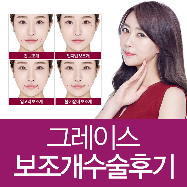 예쁜 보조개수술후기 만족스러워 관련 이미지 5