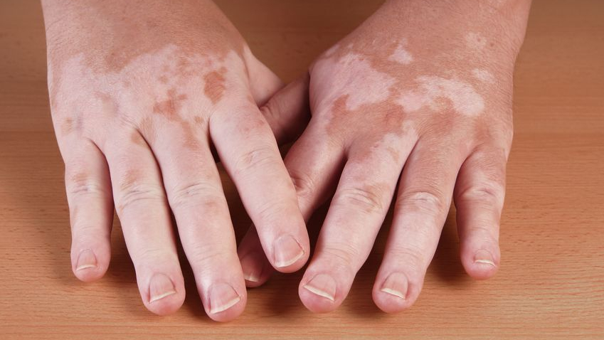 About Vitiligo image 1