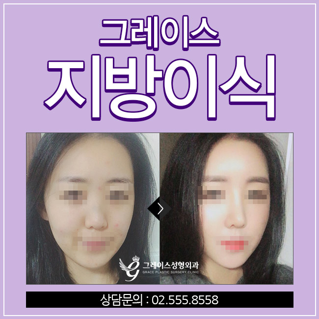 노안을 벗어나는 방법! 그레이스성형외과 얼굴지방이식후기 관련 이미지 4