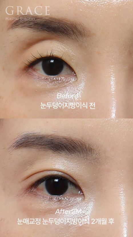 눈두덩이 지방이식 걱정만 덜기 관련 이미지 4