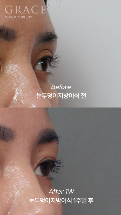 Before and After: Eyelid Fat Grafting Maintained for Over 2 Years in My Late 30s image 5