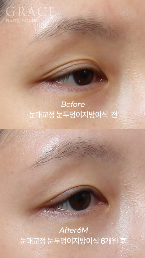 30대 눈꺼풀 지방이식 재꺼짐? 부작용? 6개월 후 관련 이미지 3