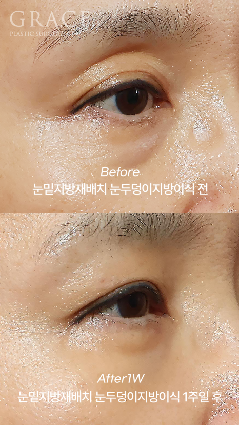 아이홀 꺼짐과 눈밑 지방을 동시에 해결하고 싶다면 관련 이미지 6