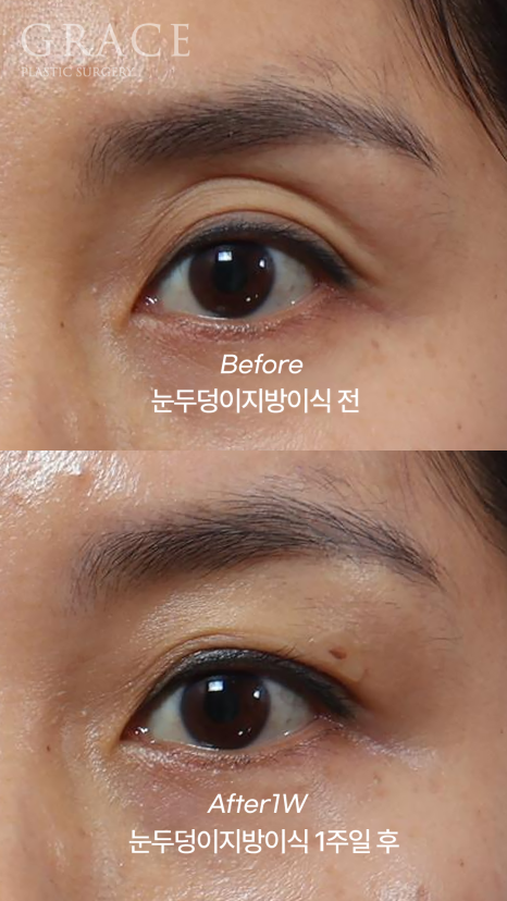 Sagging Eye Hollows and Sunken Eyelid Fat Grafting: Reasonable Cost (Price) Information and image 4