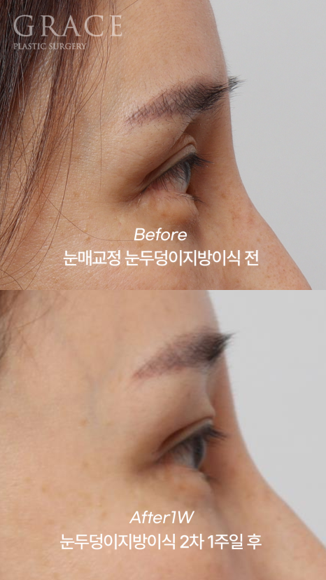 눈두덩이지방이식 2차 이식(리터치) 마취&지방채취 부위 등 관련 이미지 7