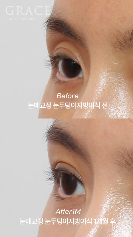 Side Effects of Eyelid Fat Grafting? One-Month Engraftment Period When Eyelid Correction Is Performed image 3