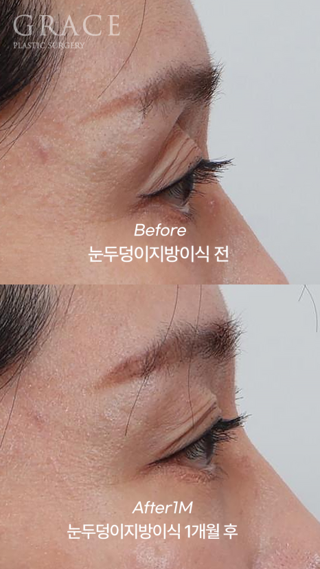 Upper Eyelid Fat Grafting Cost · Swelling, Reviews & Side Effects image 4