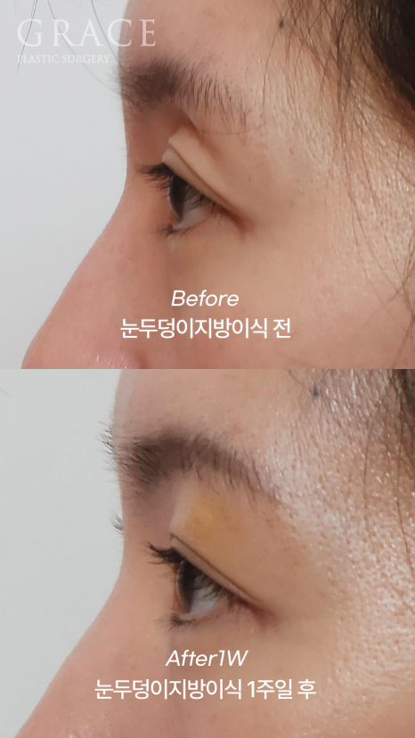 눈위꺼짐 눈두덩이 지방이식으로 자연스럽게 개선하기 관련 이미지 5